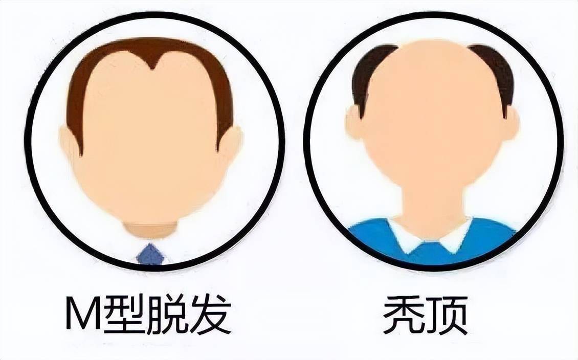 “毛发银行”来了，脱发秃顶的人有救了吗？